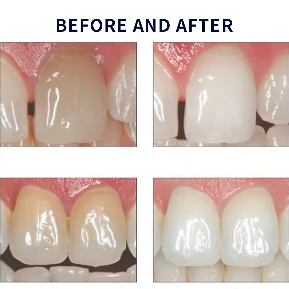 Opalwisdom-Kit de Blanchiment  - Teeth Whitening Shade Guide avis et prix