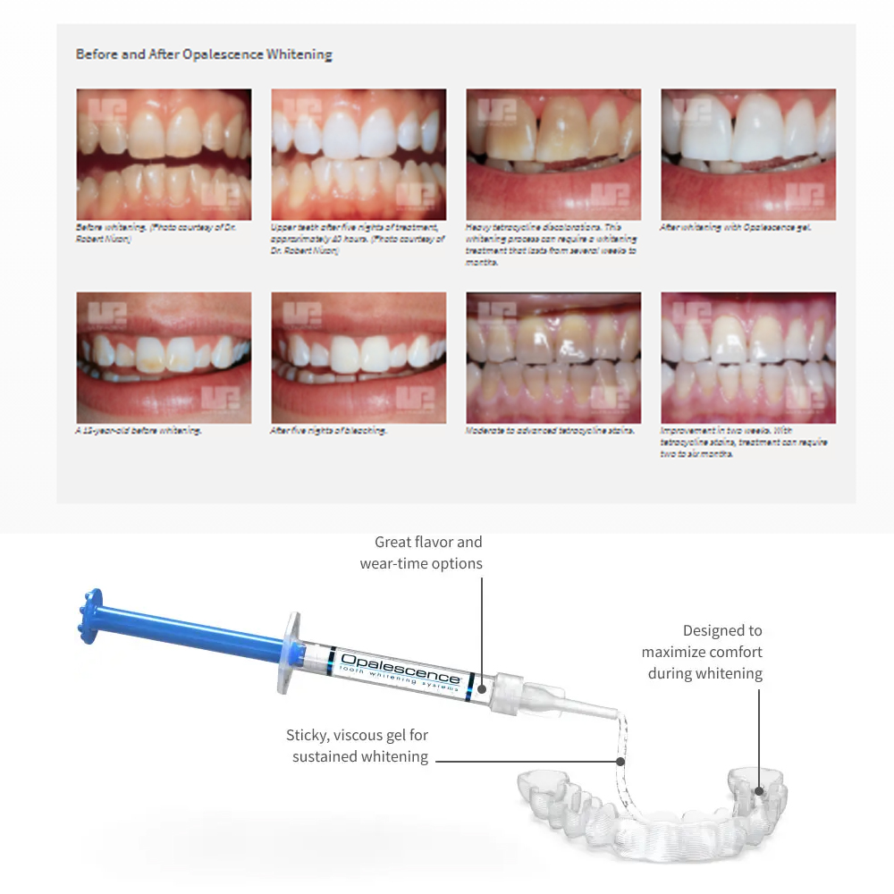 Opalwisdom-Kit de Blanchiment  - Teeth Whitening Shade Guide avis et prix